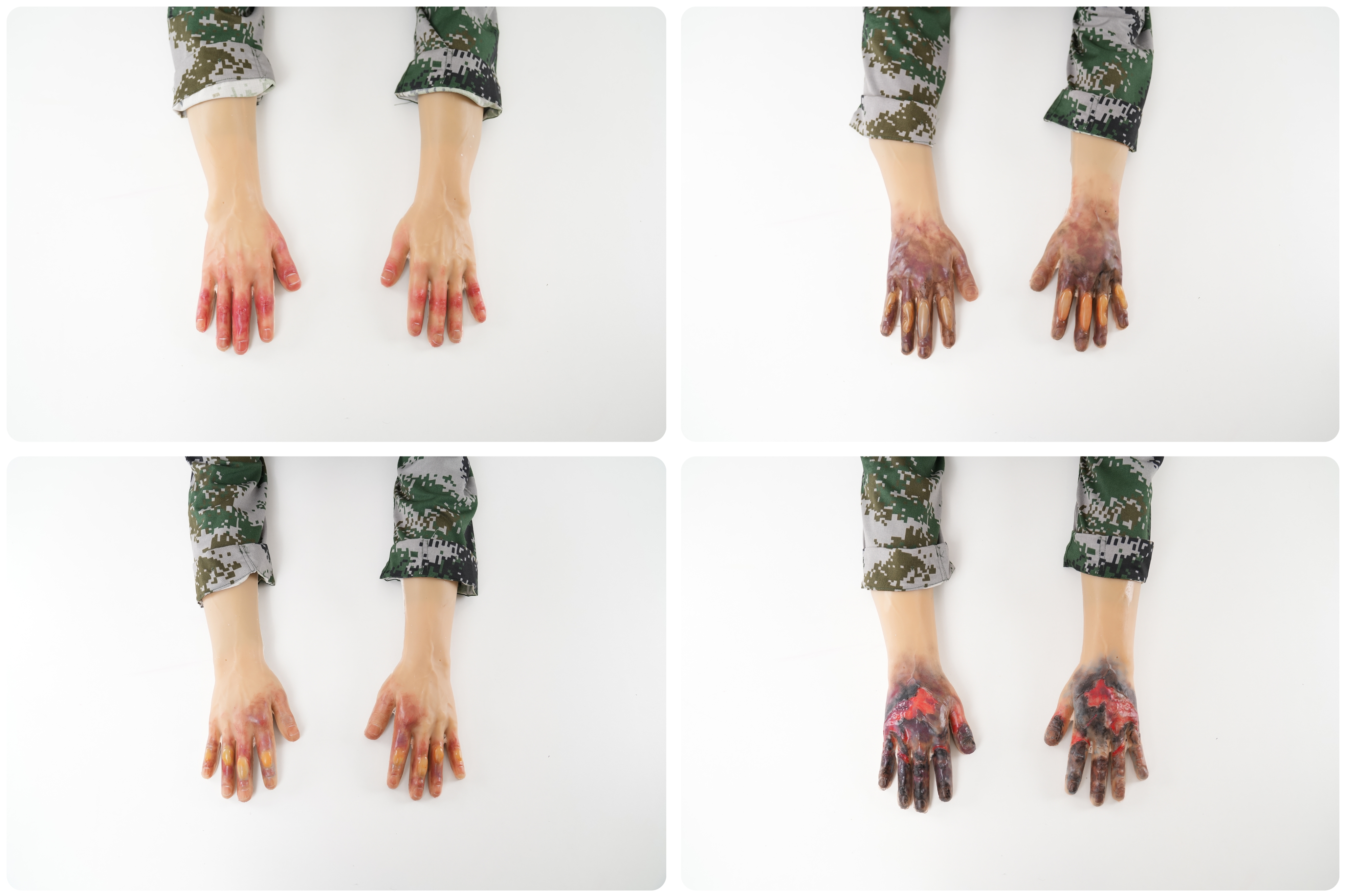 Wearable Frostbite Injury Kit   